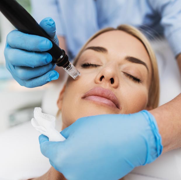 Microneedling i Stockholm