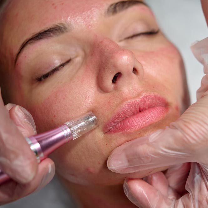Microneedling i Stockholm
